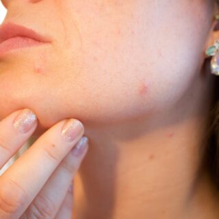 Acne Causes: Woman Holding her chin with minor acne blemishes